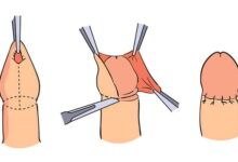 Photo of Исторические и культурные аспекты обрезания циркумцизии